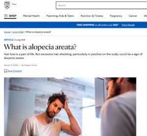 What is Alopecia Areata? - Mayo Clinic